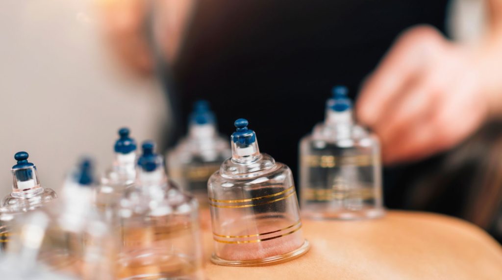 cupping therapy