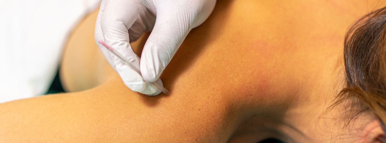 Dry needling treatment for back pain
